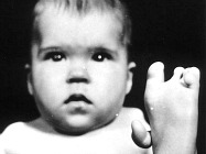 Living With Thalidomide, Euston
